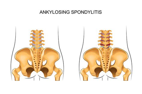 Adjustable Bed Ankylosing Spondylitis
