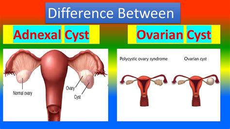 adnexal cyst in postmenopausal women