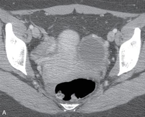 adnexal cystic lesion definition