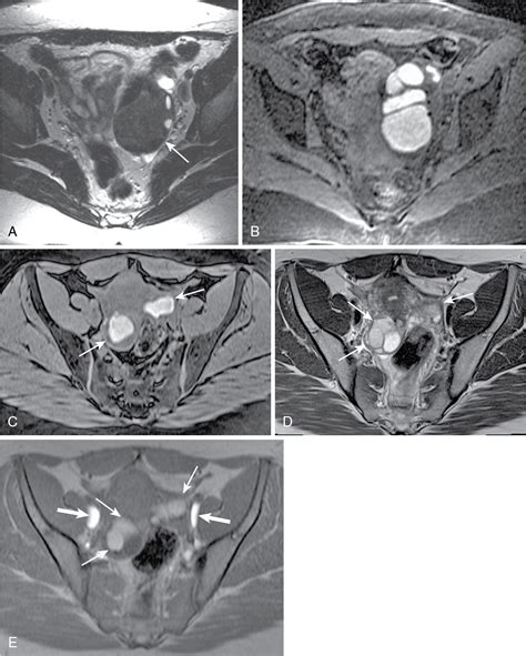 adnexal cystic lesion radiology