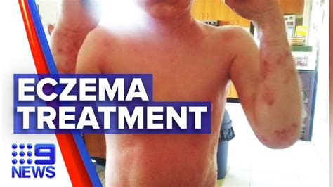adolescents eczema treatment