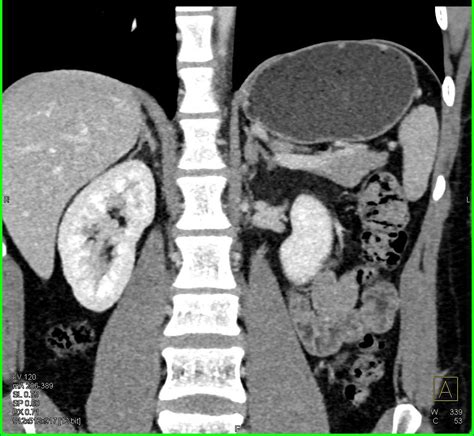 adrenal gland adenoma radiology