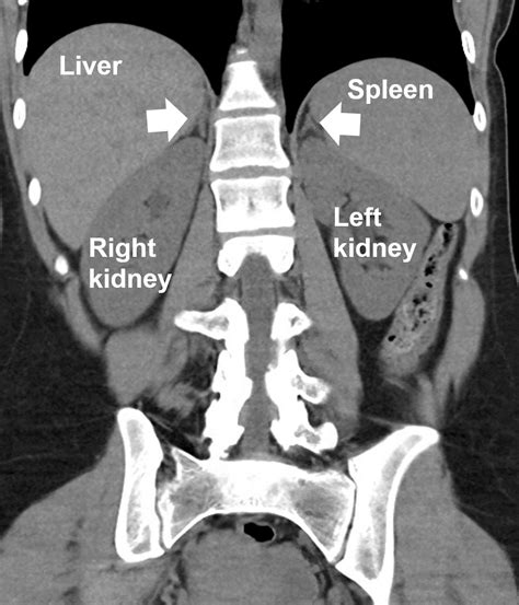 adrenal gland anatomy ct radiology