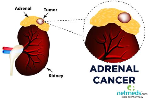 adrenal gland cancer symptoms