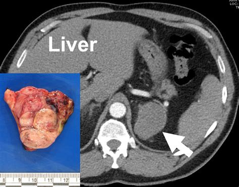 adrenal gland lesion found on ct scan