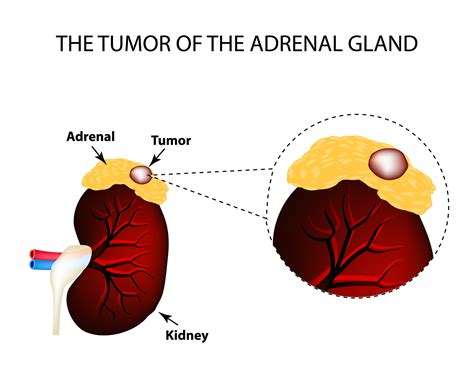 adrenal gland tumors in men