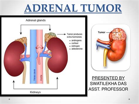 adrenal gland tumors treatment