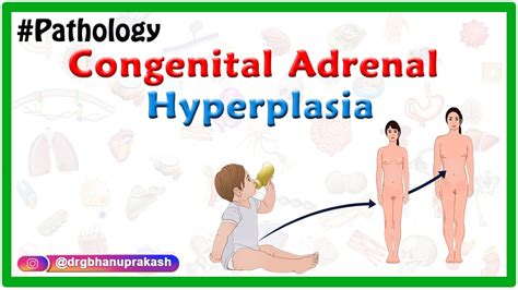 adrenal hyperplasia in children
