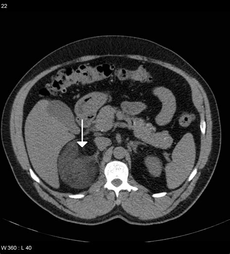 adrenal mass on ct scan