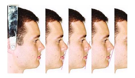 Case from drsherifsaid Flapless guided implant to preserve the soft