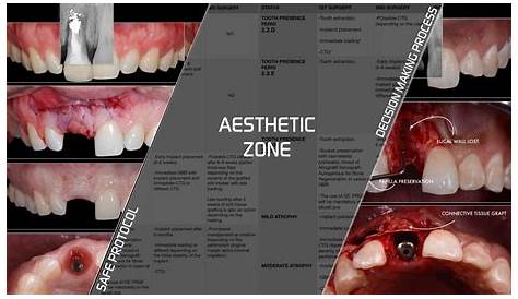 Achieving naturallooking results in the aesthetic zone Dentistry