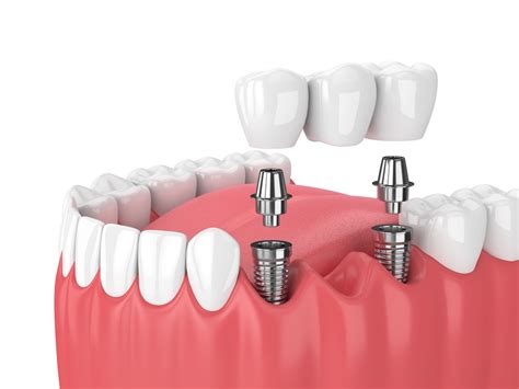 Affordable Dental Implants Arlington