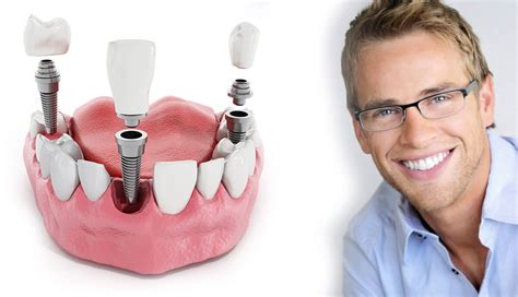 Affordable Dental Implants In Connecticut