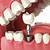 affordable dental implants in inland empire