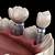 affordable dental implants in new mexico