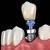 affordable dental implants lake oswego or