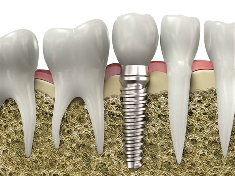 affordable dental care implants