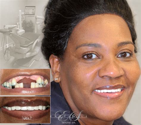 affordable dental implants brooklyn