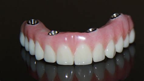 affordable dental implants in las vegas cost
