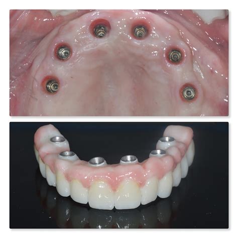 affordable dental implants pretoria