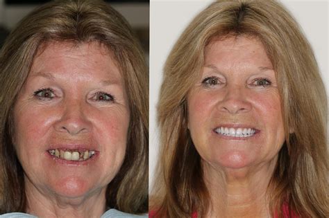 affordable dentures & implants greenville sc