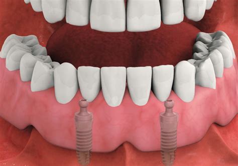 affordable dentures and implants tampa
