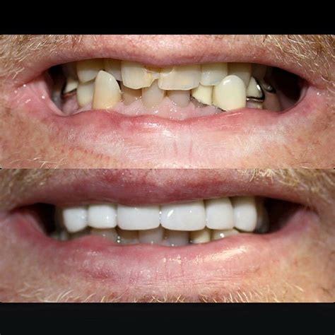 affordable dentures and implants wichita ks
