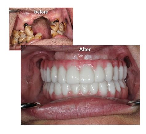 affordable dentures denver co