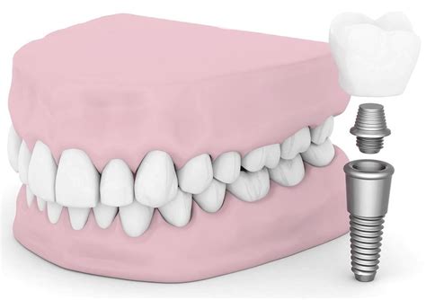 affordable implant & dental center
