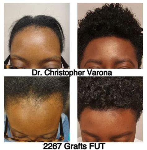 african american hair transplant near me