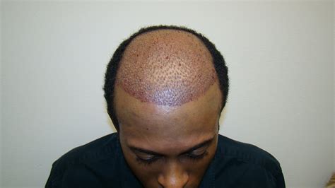 african american hair transplant specialist