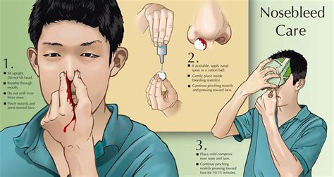 Afrin Nose Bleed: Surprising Risks and Precautions Revealed