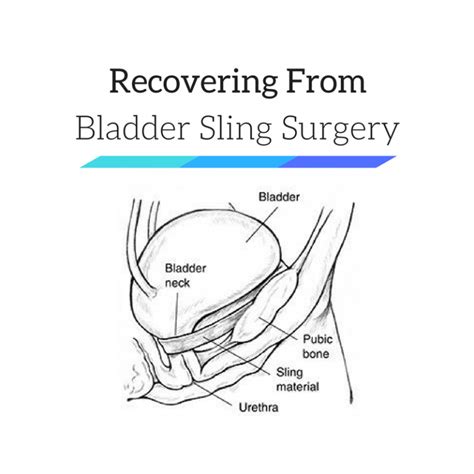 after bladder sling surgery