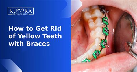 After Braces Yellow Teeth