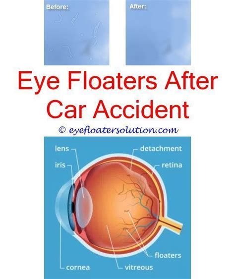 after cataract surgery floaters in eyes
