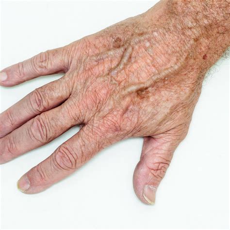 Say Goodbye to Age Spots on Hands: Effective Solutions for a Smoother You