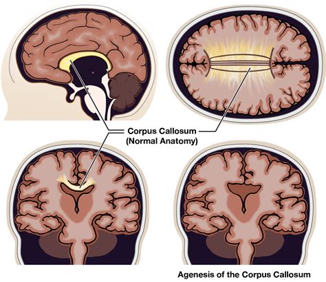agenesis of the corpus callosum therapy