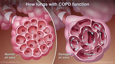 Air Conditioner Lungs