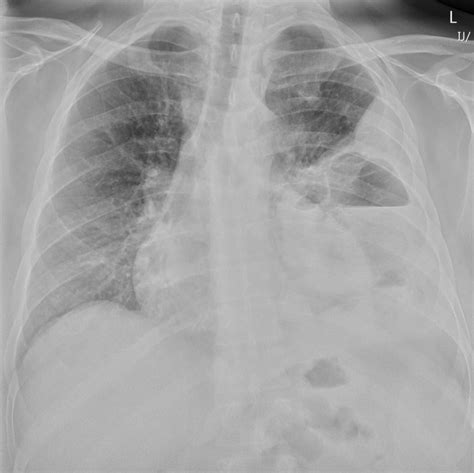 Air-Fluid Levels Cxr