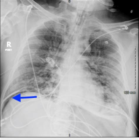 airspace disease on chest x-ray