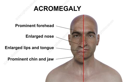 akromegali 