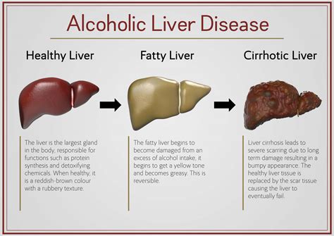 alcoholic liver disease index