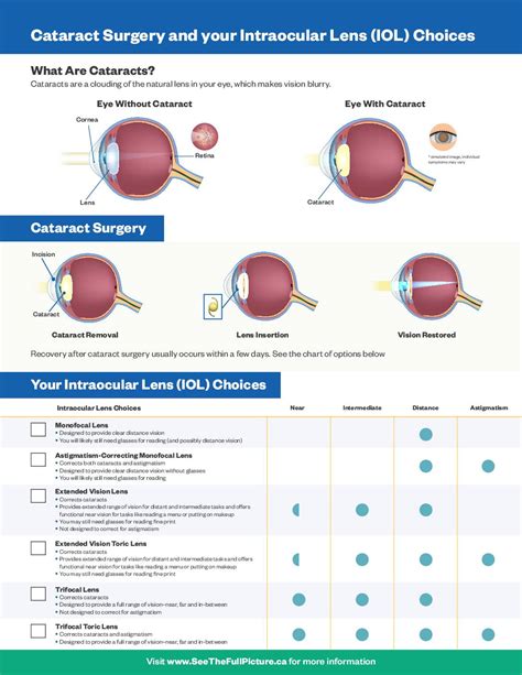 alcon lens price list for cataract surgery