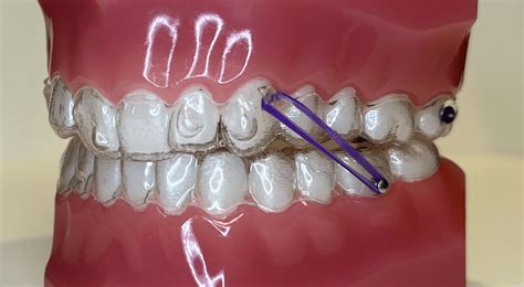 Aligners Elastics