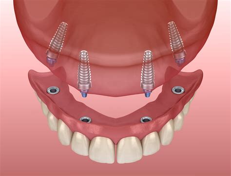 all new teeth implants