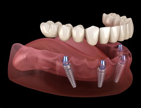 all on two dental implants