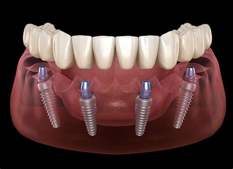all-in-4 dental implant prices costa rica