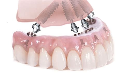 all-on-4 dental implants cost oklahoma