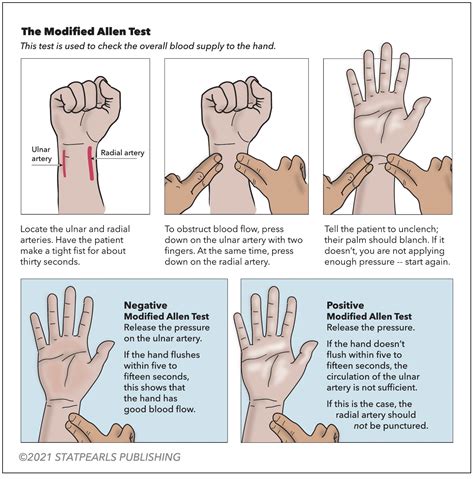 Allen Test Vs Modified Allen Test