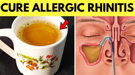 Cure Allergic Rhinitis Permanently and Naturally Using This Home Remedy